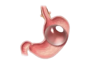 Gastric Balloon