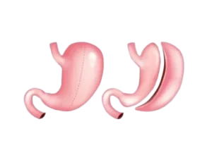 Gastric Sleeve